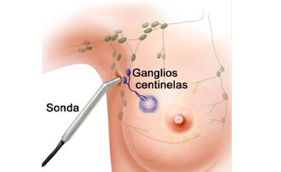 Ganglio centinela